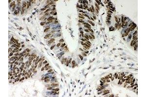 IHC-P: Nucleophosmin antibody testing of human intestine cancer tissue (NPM1 抗体  (AA 1-294))