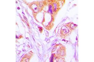 Immunohistochemical analysis of FADD staining in human lung cancer formalin fixed paraffin embedded tissue section. (FADD 抗体  (Center))
