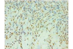 Immunohistochemistry of paraffin-embedded human breast cancer using ABIN7174129 at dilution of 1:100 (TDP1 抗体  (AA 1-260))