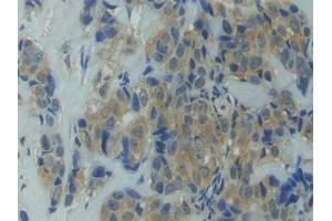 DAB staining on IHC-P; Samples: Human Breast cancer Tissue (HSP90AA1 抗体  (AA 698-732))