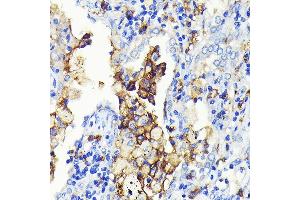 Immunohistochemistry of paraffin-embedded human lung cancer using CD14 Rabbit mAb (ABIN7266167) at dilution of 1:100 (40x lens). (CD14 抗体)