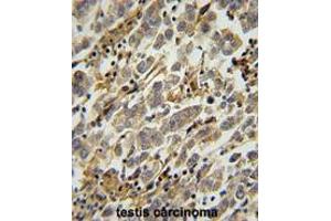 ASB17 Antibody (C-term) immunohistochemistry analysis in formalin fixed and paraffin embedded human testis carcinoma followed by peroxidase conjugation of the secondary antibody and DAB staining. (ASB17 抗体  (C-Term))