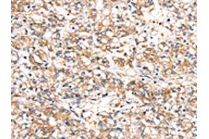 The image on the left is immunohistochemistry of paraffin-embedded Human prostate cancer tissue using ABIN7192435(SLC24A3 Antibody) at dilution 1/20, on the right is treated with synthetic peptide. (SLC24A3 抗体)