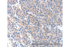 Immunohistochemistry of Human ovarian cancer using KLK2 Polyclonal Antibody at dilution of 1:100