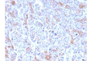 Formalin-fixed, paraffin-embedded human Pancreatic Carcinoma stained with MRP3 Mouse Monoclonal Antibody (ABCC3/2971). (ABCC3 抗体  (AA 815-957))