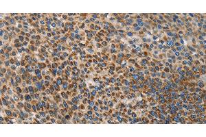 Immunohistochemistry of paraffin-embedded Human liver cancer using UPF1 Polyclonal Antibody at dilution of 1:35 (RENT1/UPF1 抗体)