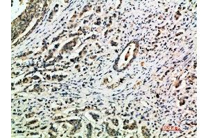 Immunohistochemical analysis of paraffin-embedded human-breast-cancer, antibody was diluted at 1:200 (Integrin alpha 1 抗体  (AA 920-980))