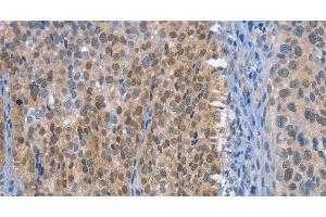 Immunohistochemistry of paraffin-embedded Human cervical cancer tissue using UCK1 Polyclonal Antibody at dilution 1:50 (UCK1 抗体)
