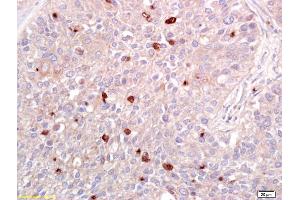 Formalin-fixed and paraffin embedded human lung carcinoma labeled with Anti-ATF2 Polyclonal Antibody, Unconjugated (ABIN669546) at 1:200 followed by conjugation to the secondary antibody and DAB staining. (ATF2 抗体  (AA 188-255))
