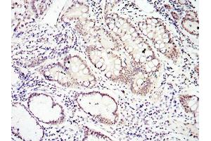 Immunohistochemical analysis of paraffin-embedded lung cancer tissues using SMAD4 mouse mAb with DAB staining.