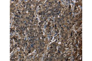 Immunohistochemistry of Human liver cancer using GSTA3 Polyclonal Antibody at dilution of 1:30 (GSTA3 抗体)