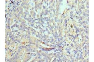 Immunohistochemistry of paraffin-embedded human lung cancer using ABIN7161635 at dilution of 1:100 (NPRL2 抗体  (AA 1-220))