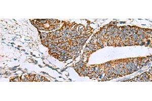 Immunohistochemistry of paraffin-embedded Human colorectal cancer tissue using PRELID3B Polyclonal Antibody at dilution of 1:90(x200) (SLMO2 抗体)