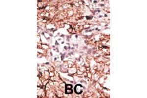 Formalin-fixed and paraffin-embedded human cancer tissue reacted with the primary antibody, which was peroxidase-conjugated to the secondary antibody, followed by DAB staining. (LSD1 抗体  (N-Term))