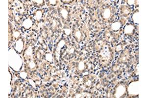 The image on the left is immunohistochemistry of paraffin-embedded Human thyroid cancer tissue using ABIN7127989(PPIL1 Antibody) at dilution 1/30, on the right is treated with fusion protein. (PPIL1 抗体)