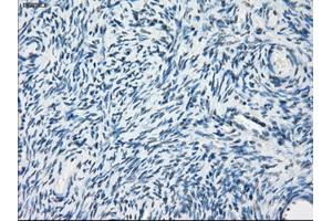 Immunohistochemical staining of paraffin-embedded Adenocarcinoma of breast tissue using anti-PDE10A mouse monoclonal antibody. (PDE10A 抗体)