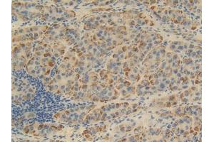 DAB staining on IHC-P; Samples: Human Liver cancer Tissue (FKBP1B 抗体  (AA 2-108))