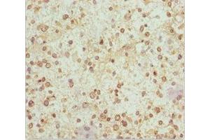 Immunohistochemistry of paraffin-embedded human glioma using ABIN7160986 at dilution of 1:100 (NDUFS1 抗体  (AA 80-290))