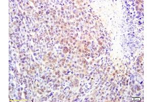 Formalin-fixed and paraffin embedded mouse lymphoma labeled with Rabbit Anti alpha MSH Polyclonal Antibody, Unconjugated (ABIN735323) at 1:200 followed by conjugation to the secondary antibody and DAB staining