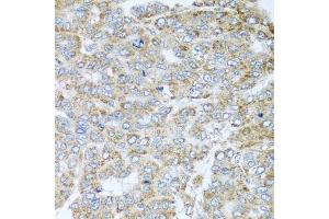 Immunohistochemistry of paraffin-embedded human liver cancer using NDUFA2 antibody. (NDUFA2 抗体)
