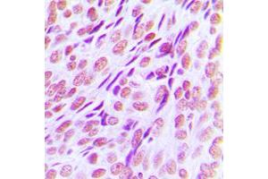 Immunohistochemical analysis of RUNX1 staining in human breast cancer formalin fixed paraffin embedded tissue section. (RUNX1 抗体  (Center))