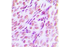 Immunohistochemical analysis of RUNX1 staining in human breast cancer formalin fixed paraffin embedded tissue section.