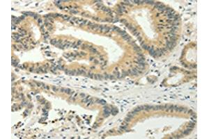 The image on the left is immunohistochemistry of paraffin-embedded Human colon cancer tissue using ABIN7128020(SPIN4 Antibody) at dilution 1/20, on the right is treated with fusion protein. (SPIN4 抗体)