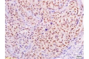 Formalin-fixed and paraffin embedded transplanted tumor of cervical carcinoma in nude mice labeled with Anti-MTA1 Polyclonal Antibody, Unconjugated (ABIN686182) at 1:300, followed by conjugation to the secondary antibody and DAB staining (MTA1 抗体  (AA 601-715))