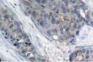 Immunohistochemistry (IHC) analyzes of p-IRS-1 antibody in paraffin-embedded human breast carcinoma tissue. (IRS1 抗体  (pSer307))