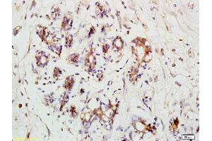 Formalin-fixed and paraffin embedded human breast carcinoma labeled with Anti- RPS3 Polyclonal Antibody, Unconjugated (ABIN872550) at 1:200 followed by conjugation to the secondary antibody (RPS3 抗体  (AA 101-200))