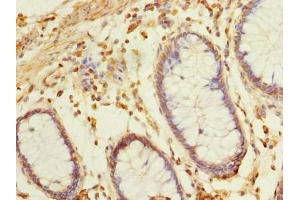 Immunohistochemistry of paraffin-embedded human colon cancer using ABIN7145650 at dilution of 1:100 (BRINP2 抗体  (AA 34-300))