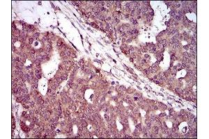Immunohistochemical analysis of paraffin-embedded ovarian cancer tissues using PIWIL4 mouse mAb with DAB staining. (PIWIL4 抗体  (AA 304-434))