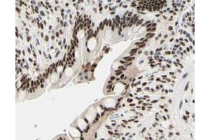 ABIN6267567 at 1/200 staining human colon cancer tissue sections by IHC-P. (Histone H3.1 抗体  (pSer10))