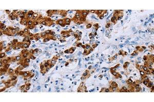 Immunohistochemistry of paraffin-embedded Human liver cancer tissue using NDUFA12 Polyclonal Antibody at dilution 1:50 (NDUFA12 抗体)