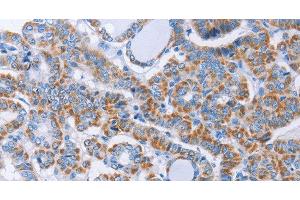 Immunohistochemistry of paraffin-embedded Human thyroid cancer using KIF3A Polyclonal Antibody at dilution of 1:40 (KIF3A 抗体)