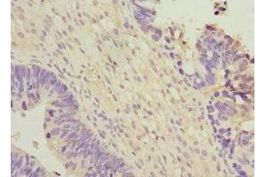 Immunohistochemistry of paraffin-embedded human ovarian cancer using ABIN7166313 at dilution of 1:100 (WNT7B 抗体  (AA 120-349))