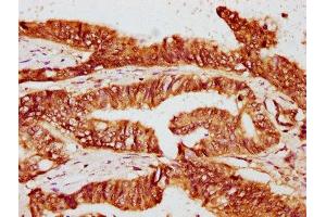 IHC image of ABIN7162837 diluted at 1:400 and staining in paraffin-embedded human colon cancer performed on a Leica BondTM system. (FKBP4 抗体  (AA 1-240))