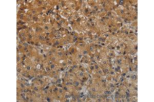 Immunohistochemistry of Human thyroid cancer using TAB1 Polyclonal Antibody at dilution of 1:40 (TAB1 抗体)