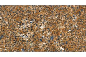 Immunohistochemistry of paraffin-embedded Human liver cancer tissue using NPAP1 Polyclonal Antibody at dilution 1:60 (NPAP1 抗体)