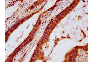 IHC image of ABIN7142854 diluted at 1:600 and staining in paraffin-embedded human colon cancer performed on a Leica BondTM system. (DHCR7 抗体  (AA 63-147))