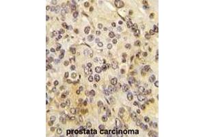 Formalin-fixed and paraffin-embedded human prostata carcinoma tissue reacted with MEN1 Antibody  (ABIN391614 and ABIN2841535) , which was peroxidase-conjugated to the secondary antibody, followed by DAB staining. (Menin 抗体  (AA 584-615))