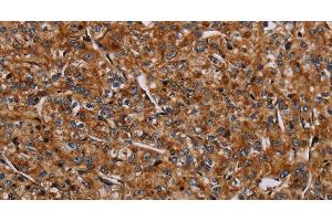 Immunohistochemistry of paraffin-embedded Human prostate cancer using NDUFA8 Polyclonal Antibody at dilution of 1:40 (NDUFA8 抗体)