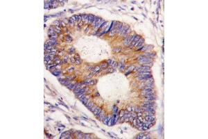 Formalin-fixed and paraffin-embedded human colon carcinoma tissue reacted with FXN antibody (Center) (ABIN390378 and ABIN2840780) , which was peroxidase-conjugated to the secondary antibody, followed by DAB staining. (Frataxin 抗体  (AA 72-102))