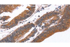 Immunohistochemistry of paraffin-embedded Human colon cancer tissue using GREB1 Polyclonal Antibody at dilution 1:40 (GREB1 抗体)