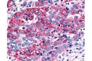 Anti-GABABR1 / GABBR1 antibody IHC of human Ovary, Carcinoma. (GABBR1 抗体  (N-Term))