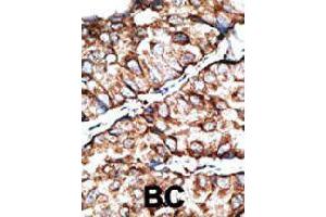 Formalin-fixed and paraffin-embedded human cancer tissue reacted with DKKL1 polyclonal antibody  , which was peroxidase-conjugated to the secondary antibody, followed by DAB staining. (DKK1 抗体  (C-Term))