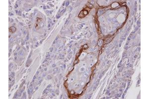 IHC-P Image Immunohistochemical analysis of paraffin-embedded Ca922 xenograft, using CROT, antibody at 1:100 dilution. (CROT 抗体)