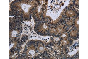 Immunohistochemistry of Human liver cancer using GK Polyclonal Antibody at dilution of 1:60 (Glycerol Kinase 抗体)