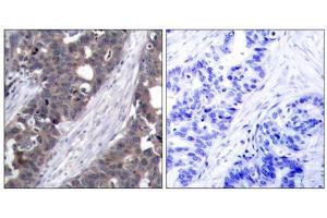 Immunohistochemical analysis of paraffin-embedded human breast carcinoma tissue using p70 S6 Kinase (Ab-411) antibody (E021261). (RPS6KB1 抗体)