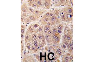 Formalin-fixed and paraffin-embedded human hepatocellular carcinoma reacted with PIM3 polyclonal antibody  , which was peroxidase-conjugated to the secondary antibody, followed by DAB staining. (PIM3 抗体  (C-Term))